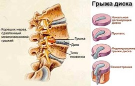 Грыжа позвоночника- не приговор!