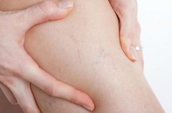 9 опасных признаков тромбоза, которые нельзя игнорировать