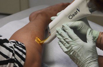ClearV – лазерное удаление сосудов нового поколения
