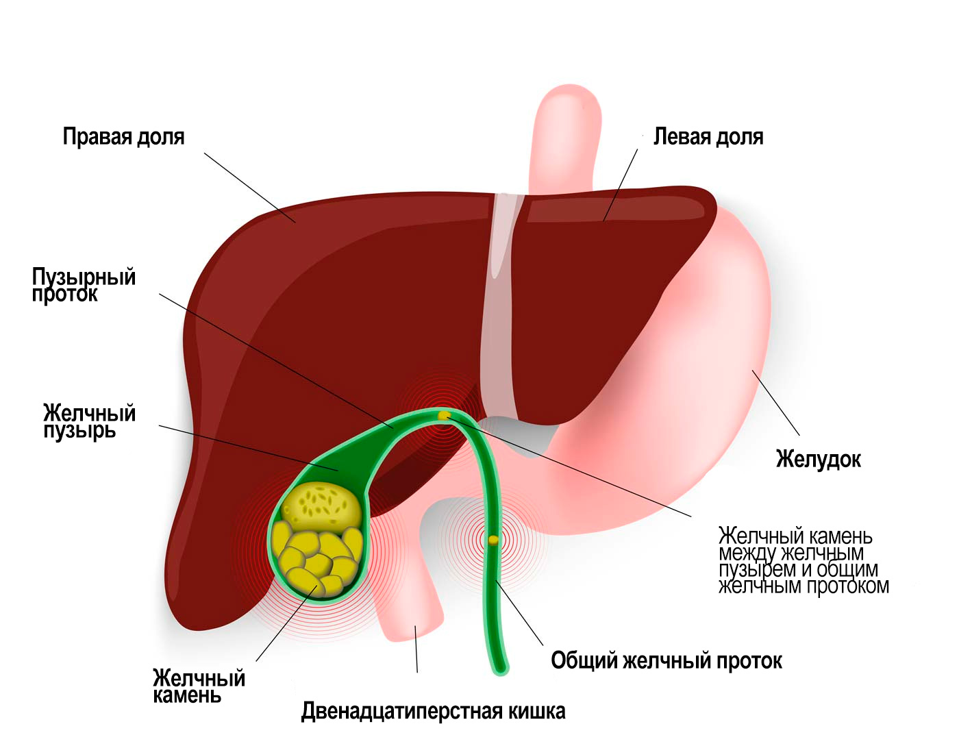Желчные камни