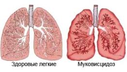 Муковисцидоз Муковисцидоз